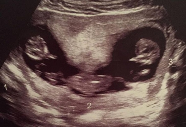 40 Trillizos Idénticos 20 40 Trillizos Idénticos 20