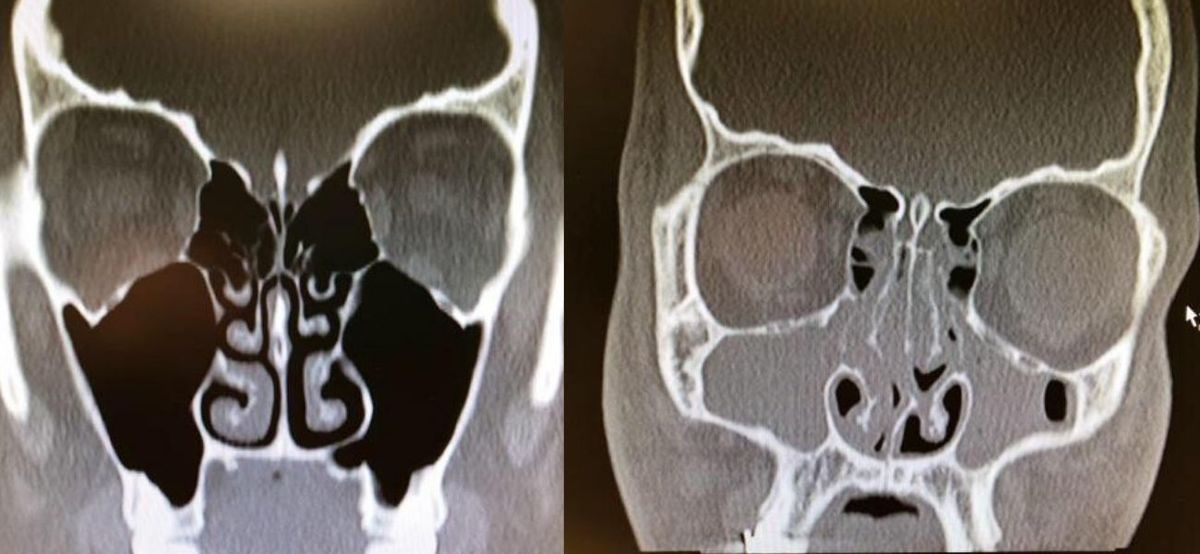 congested and uncongested xray