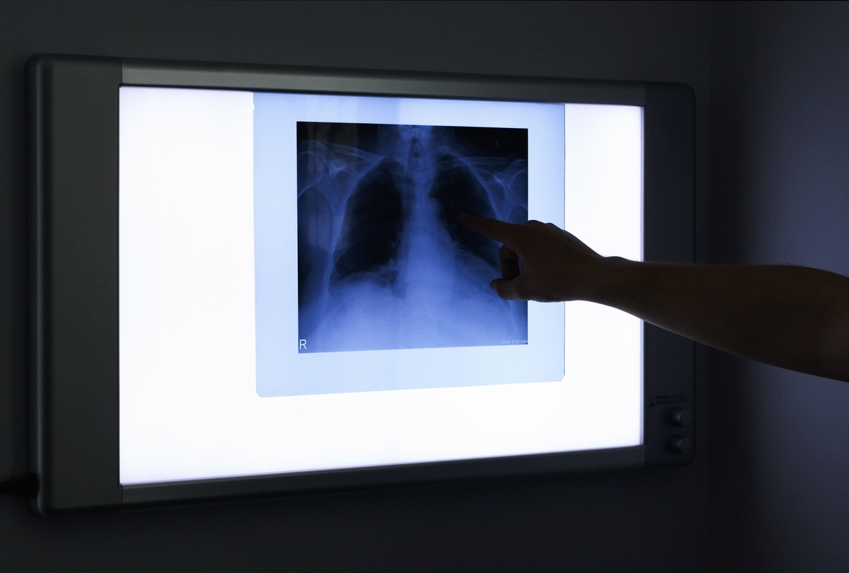 X-ray of patients chest is being reviewed on an illuminated wall-mounted monitoring screen.
