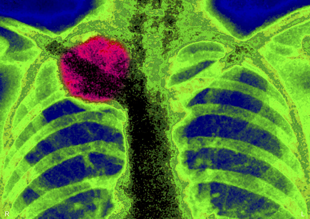Cancer -151046933 X-ray of tumor