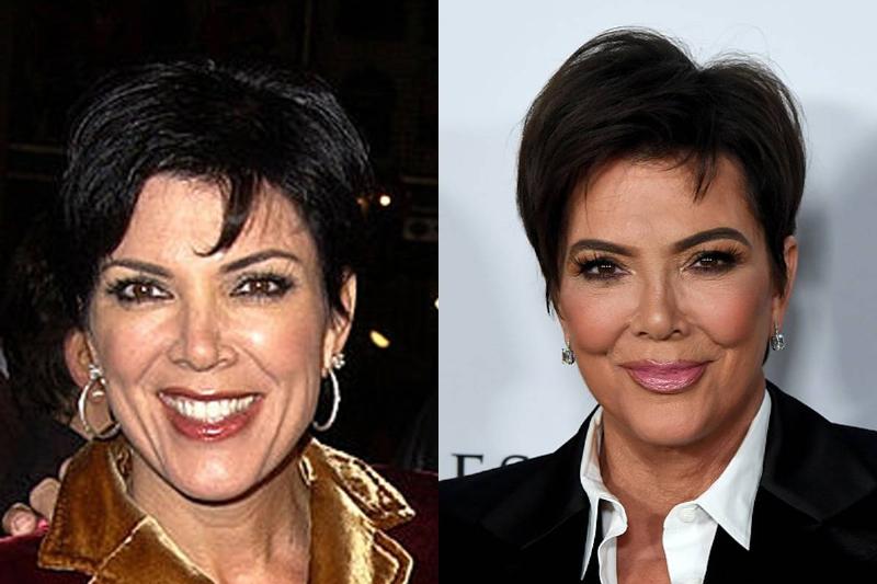 kris-jenner-before-after-plastic-surgery