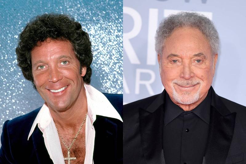 tom-jones-before-after-plastic-surgery