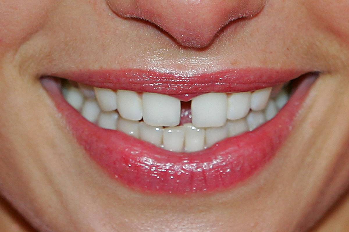 A close-up shows a supermodel's teeth.