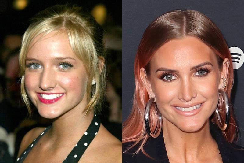 ashlee-simpson-plastic-surgery