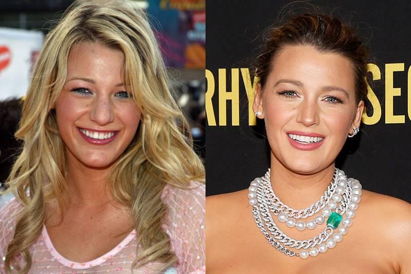 blake-lively-plastic-surgery