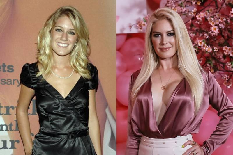 heidi-montag-plastic-surgery