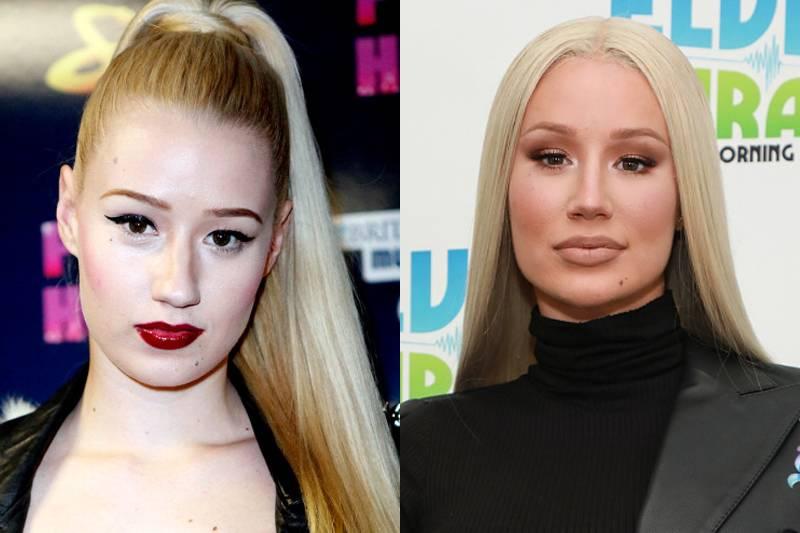 iggy-azalea-plastic-surgery