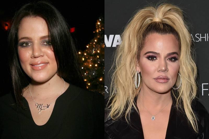 khloe-kardashian-plastic-surgery
