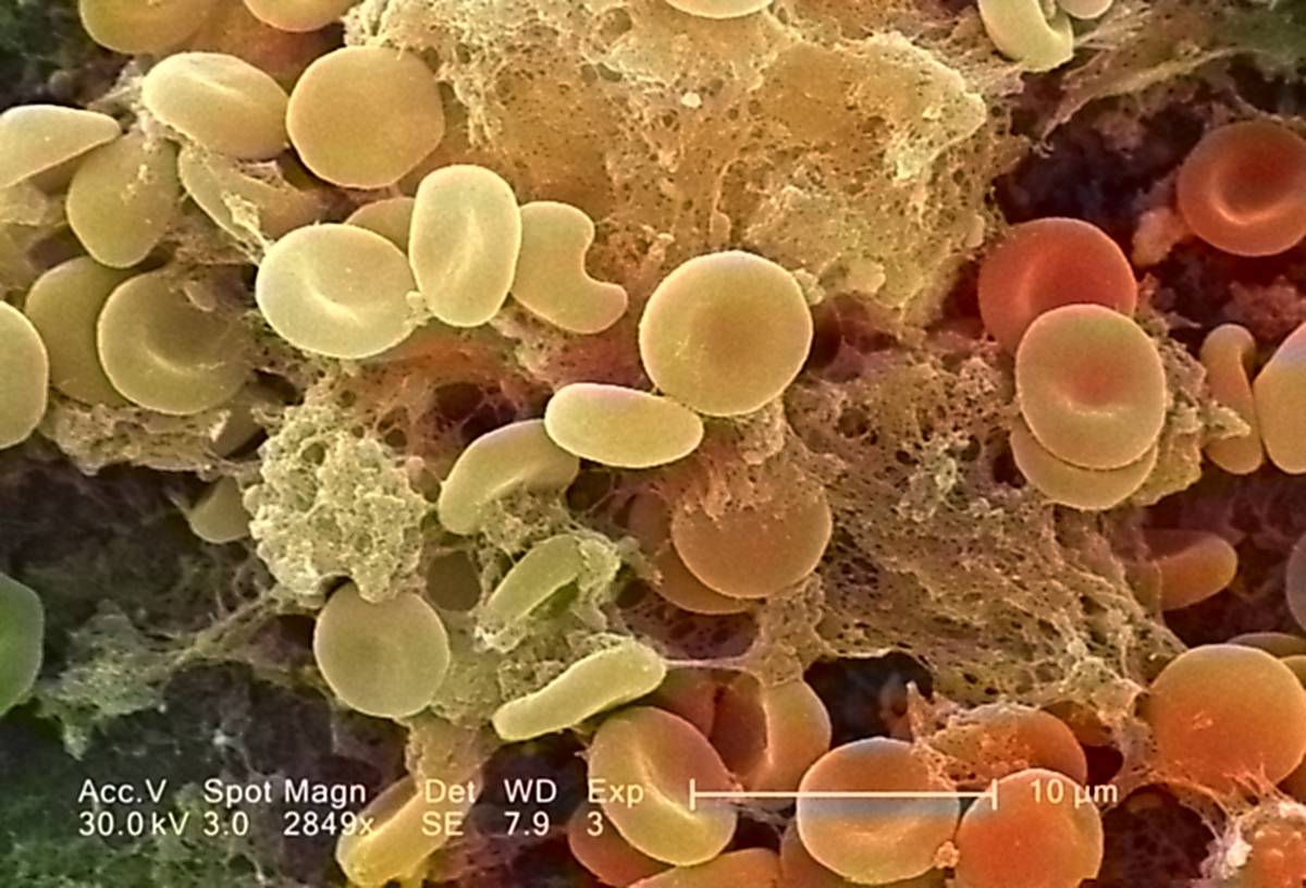 An illustration shows red blood cells.