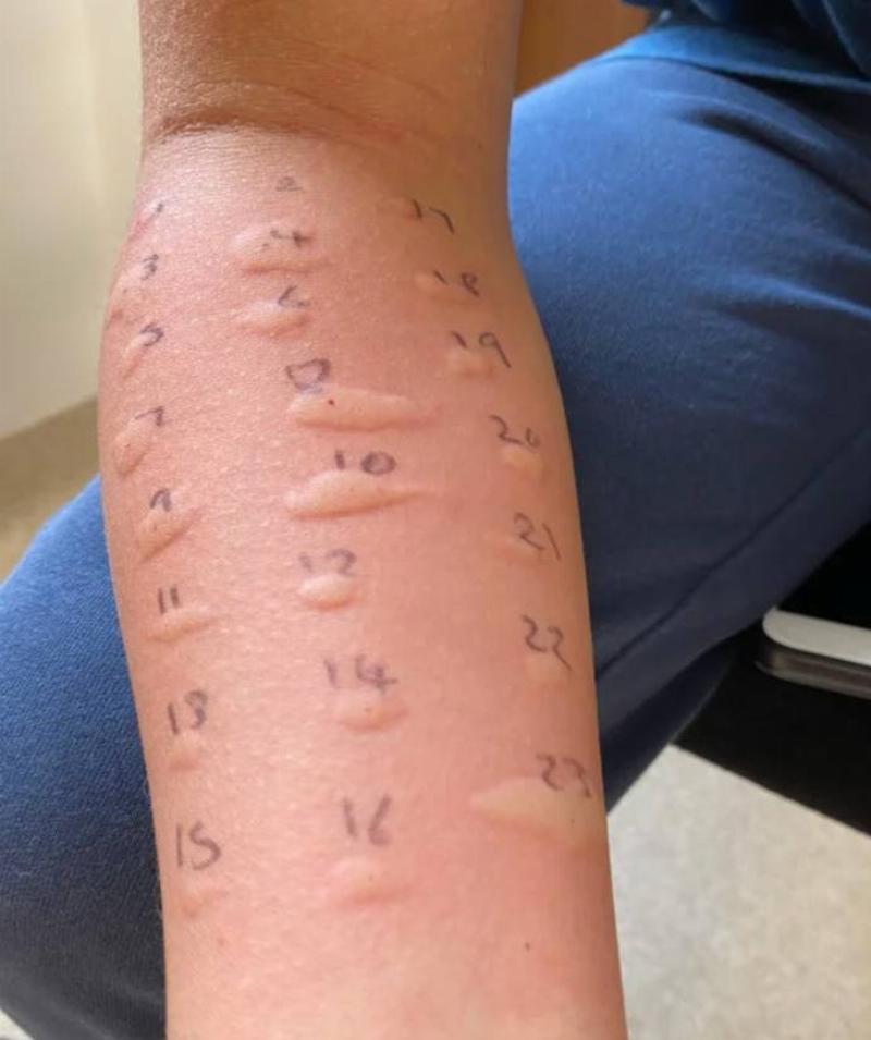 person with all spots on their arm swollen from allergy test