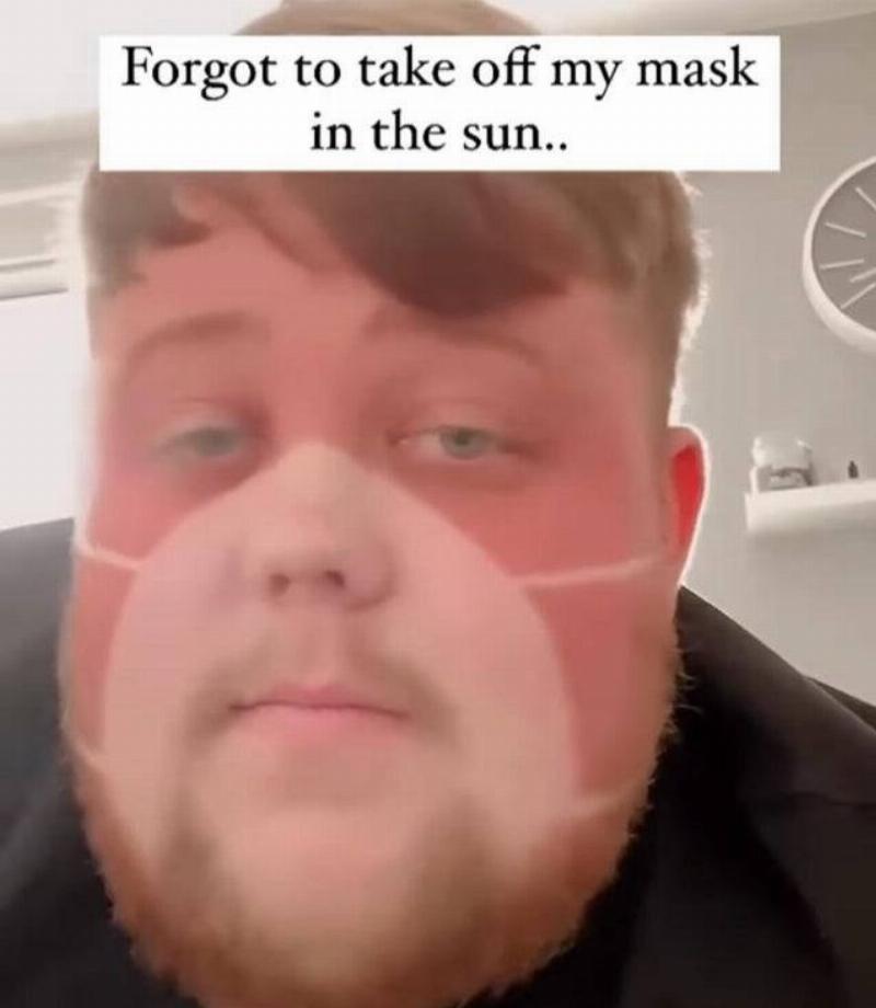 mask sunburn 