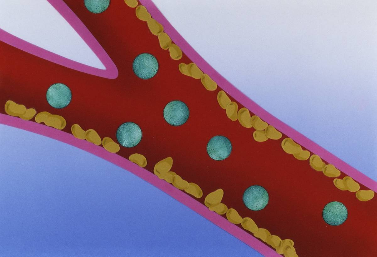 njm-artery Circulatory system, artery with LDL lipoprotein and cholesterol, drawing