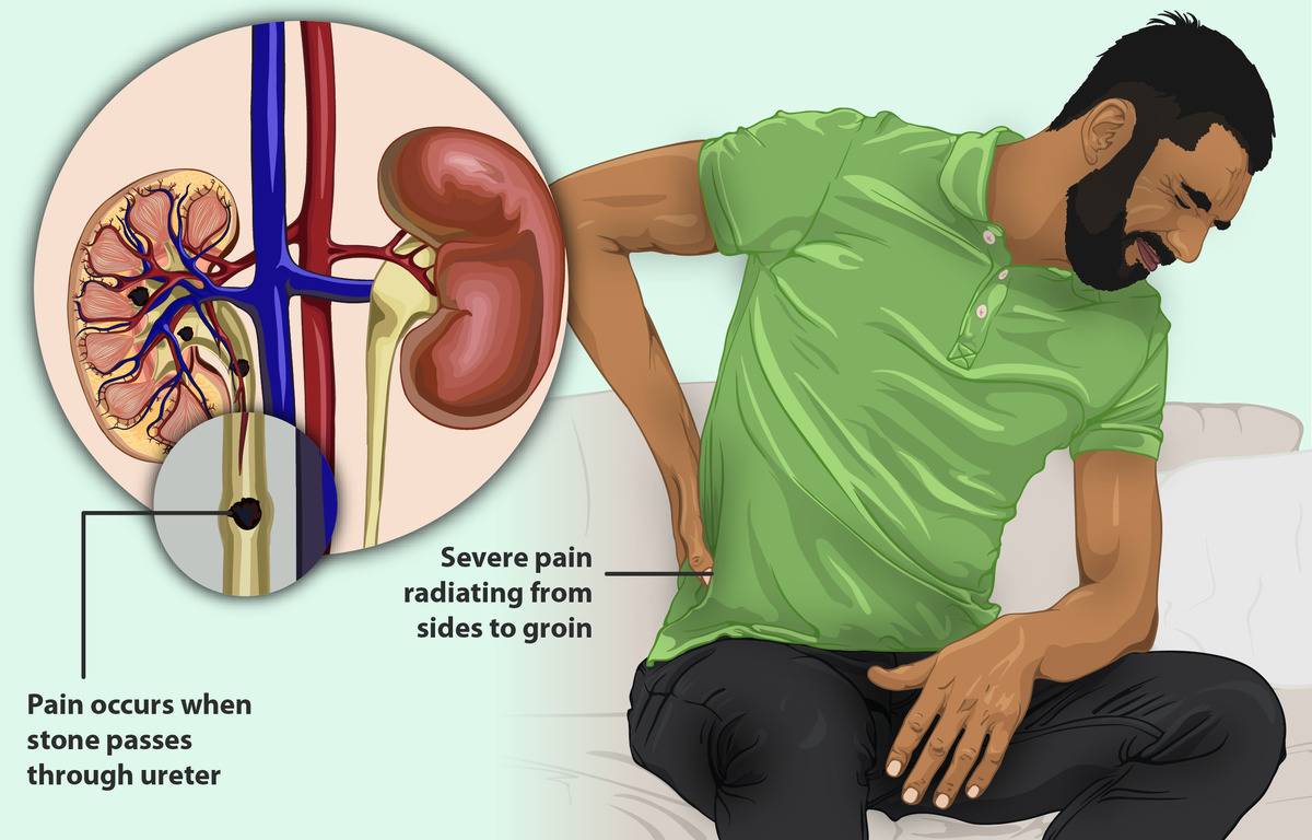 njm-kidney A_man_with_Kidney_Stones