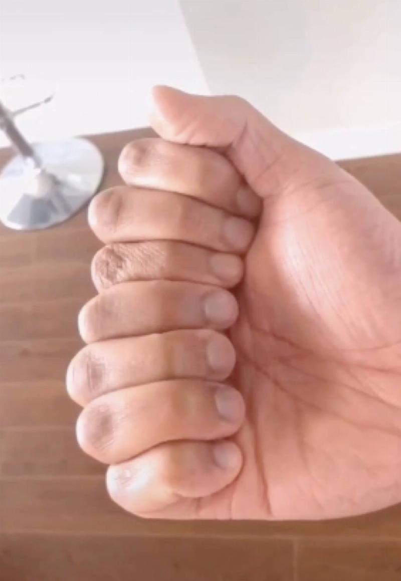 wide hand with seven fingers
