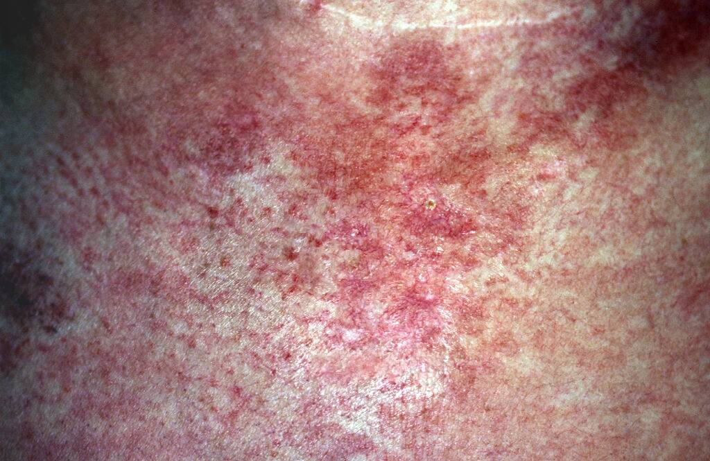 Dermatomyositis