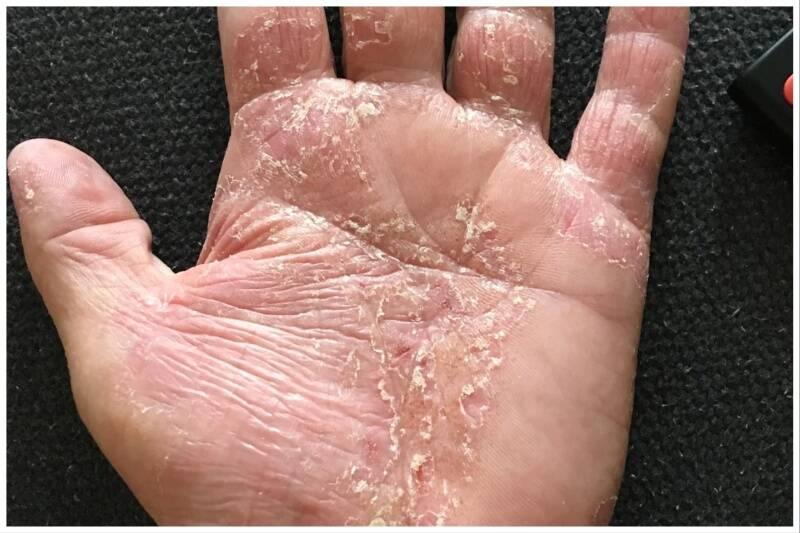 Eczema