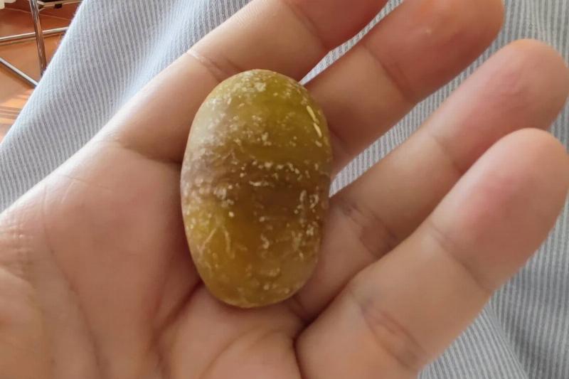 gallstone gallstone