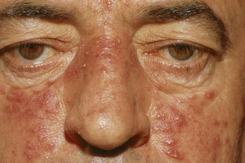 Acne Rosacea