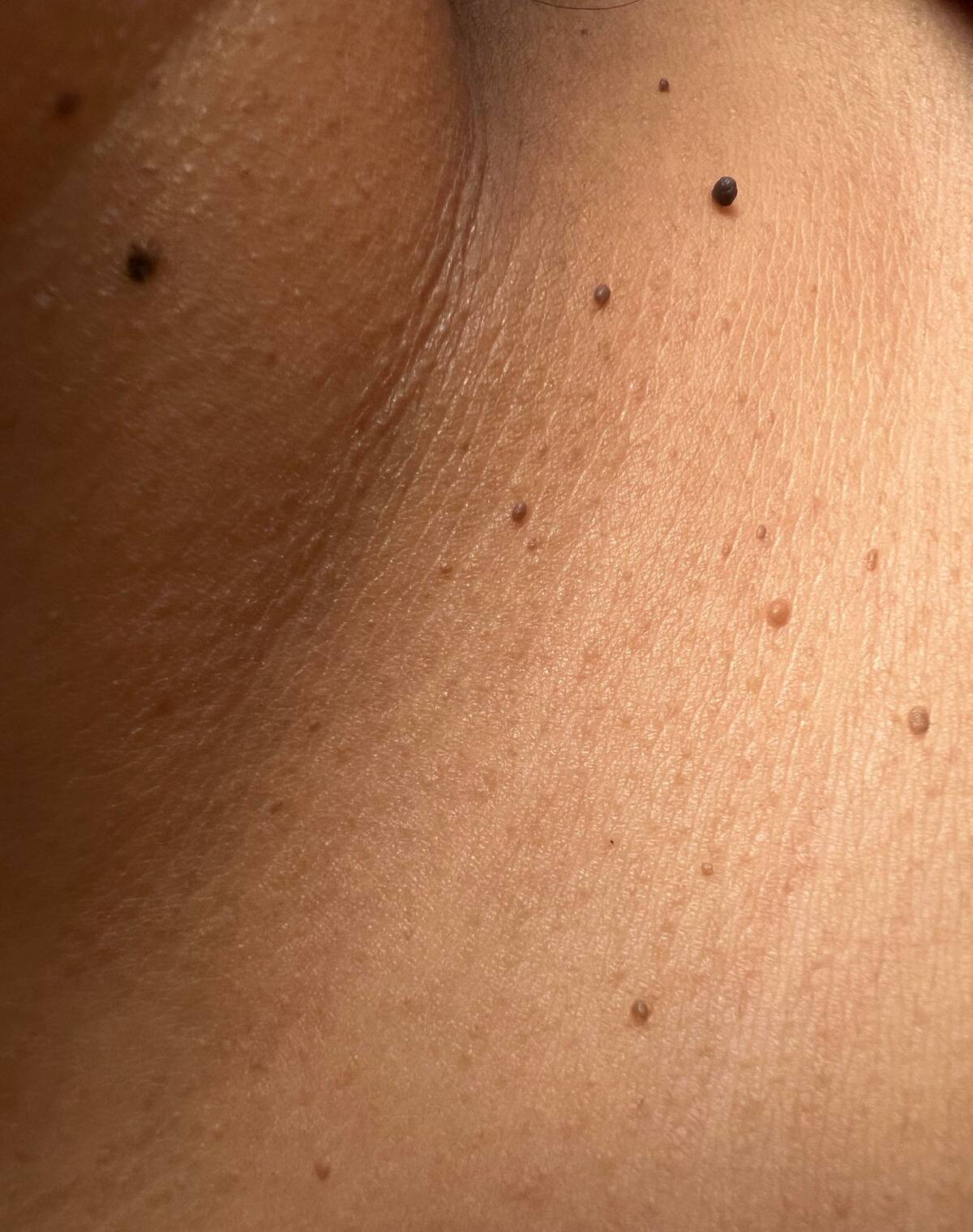 skin tags