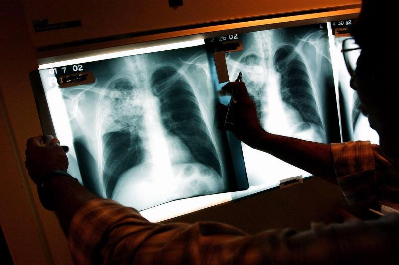 Healthcare Workers Fight TB In The Inner City Healthcare Workers Fight TB In The Inner City